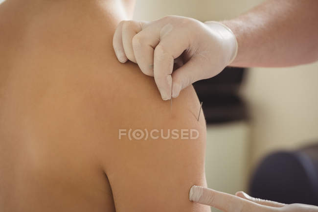 Primer plano del fisioterapeuta realizando agujas secas en el hombro del paciente en la clínica - foto de stock