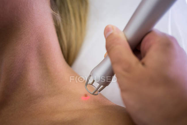 Dermatologist removing mole from patient shoulder with medical laser — Stock Photo
