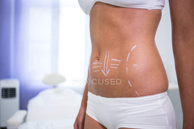 Mittelteil des weiblichen Körpers mit Zeichnungsmarken für den Bauch zur Fettabsaugung und Entfernung von Cellulite — Stockfoto
