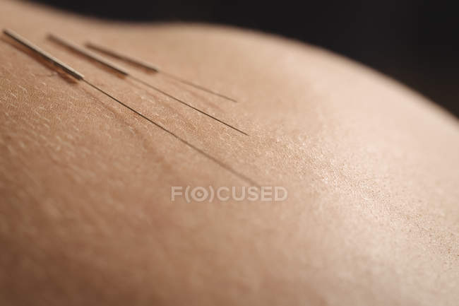 Close-up de três agulhas para agulhas secas na pele — Fotografia de Stock