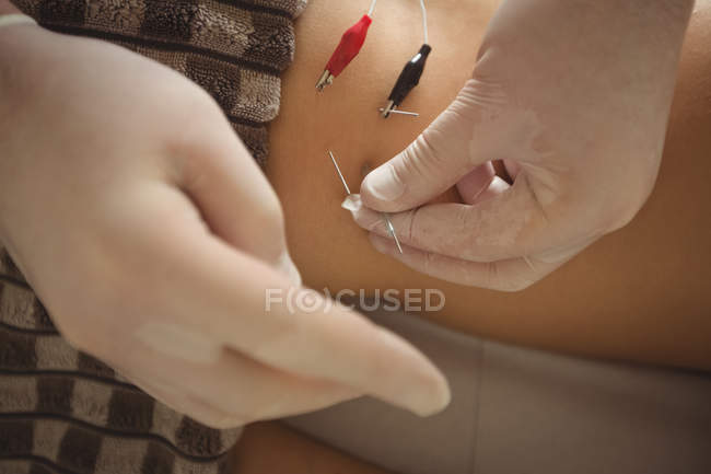 Fisioterapeuta realizando agulhas eletro-secas na cintura do paciente — Fotografia de Stock