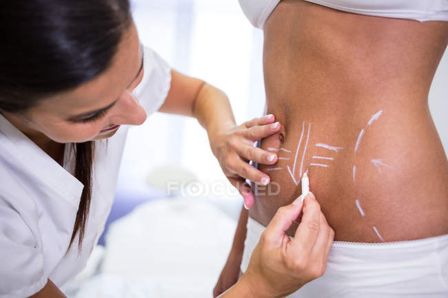 Nahaufnahme des Chirurgen beim Zeichnen von Linien am weiblichen Bauch zur Fettabsaugung und Entfernung von Cellulite — Stockfoto