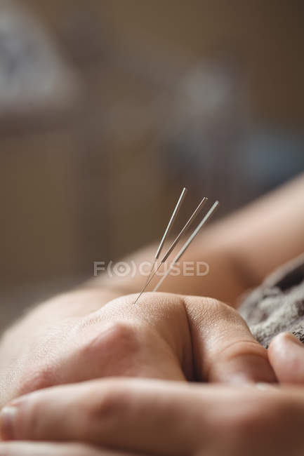 Close-up de um paciente recebendo agulhas secas na mão — Fotografia de Stock