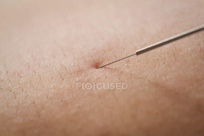Close-up of patient getting dry needling on back — Stock Photo