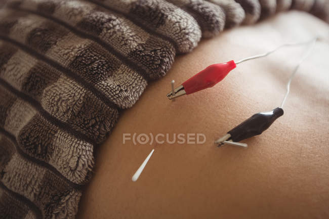 Close-up of patient getting electro dry needling on waist — Stock Photo