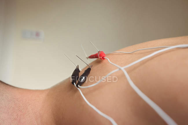 Close-up of patient getting electro dry needling on shoulder in clinic — Stock Photo
