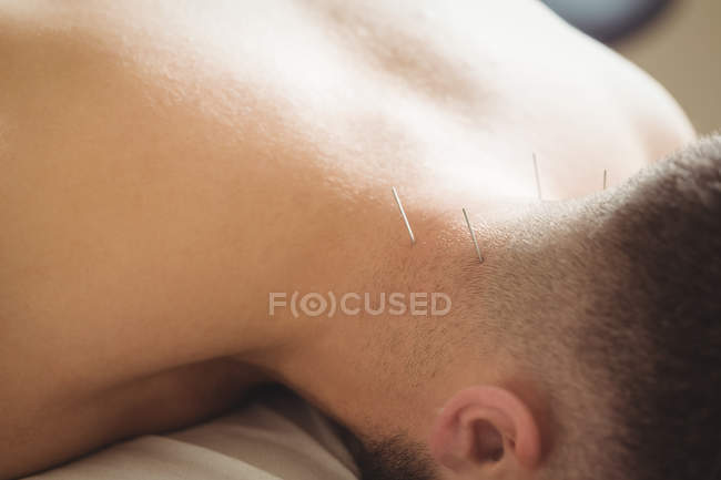Primer plano del paciente recibiendo agujas secas en la parte posterior del cuello - foto de stock
