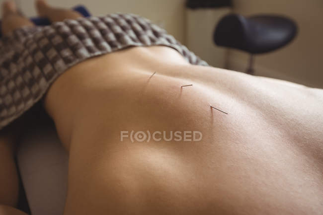 Primo piano del paziente che si asciuga con l'ago sulla schiena — Foto stock