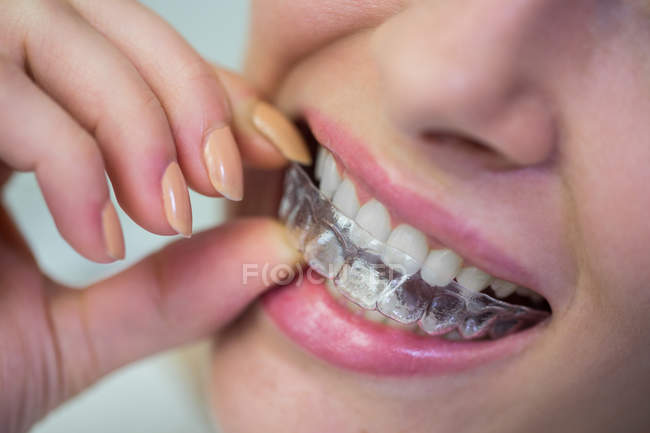 Крупним планом жінка в ортодонтичних силіконових невидимих брекетах — стокове фото