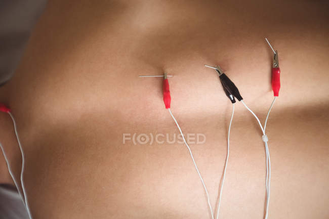 Close-up de paciente recebendo agulha electro seco de volta na clínica — Fotografia de Stock