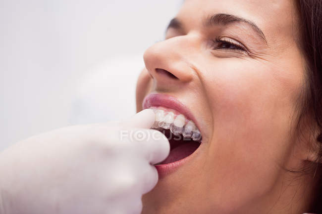 Dentist assisting female patient to wearing braces in dental clinic — Stock Photo