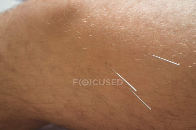Close-up de paciente do sexo masculino recebendo agulhas secas no joelho — Fotografia de Stock