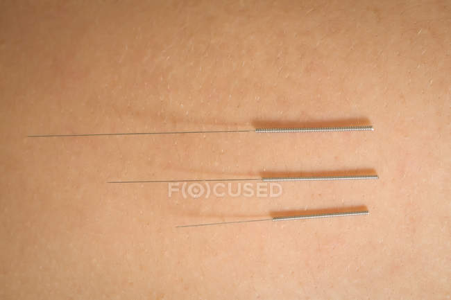Primer plano de tres agujas para agujas secas en la piel - foto de stock