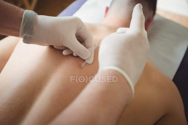 Gros plan du physiothérapeute pratiquant l'aiguille sèche sur le dos d'un patient à la clinique — Photo de stock