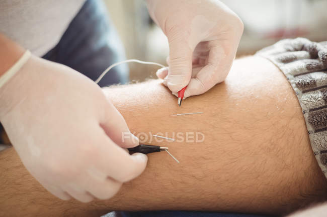Gros plan des mains du physiothérapeute effectuant une aiguille électro-sèche sur le genou du patient masculin — Photo de stock
