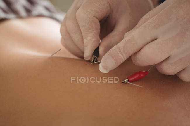 Close-up de fisioterapeuta realizando agulhas eletro-secas nas costas de um paciente na clínica — Fotografia de Stock