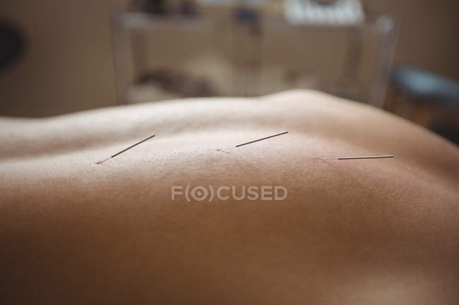 Close-up of patient getting dry needling on back — Stock Photo