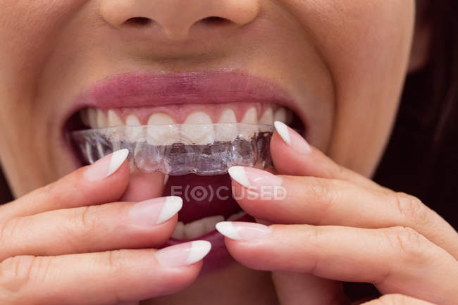 Primo piano della paziente che indossa l'apparecchio in clinica dentale — Foto stock
