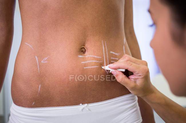 Nahaufnahme des Chirurgen beim Zeichnen von Linien am weiblichen Patientenbauch zur Fettabsaugung und Entfernung von Cellulite — Stockfoto