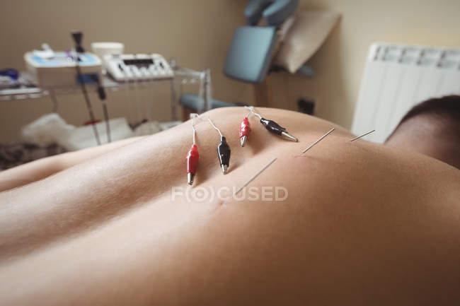 Gros plan du patient recevant des aiguilles électro-sèches à son retour à la clinique — Photo de stock