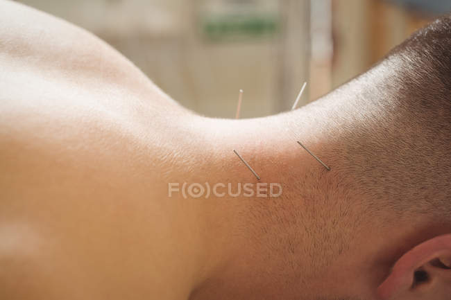 Primo piano del paziente di sesso maschile che ottiene l'ago secco sul collo — Foto stock