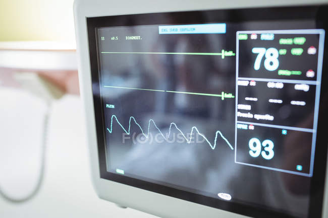 Крупный план монитора жизненно важных показателей в больнице — стоковое фото
