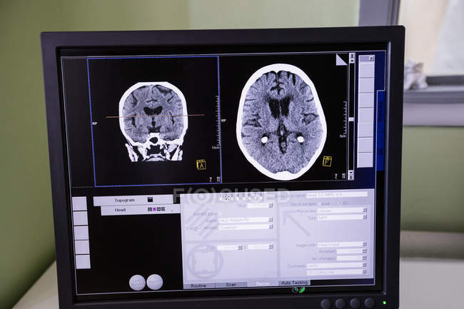 Exploración cerebral digital en monitor de computadora en el hospital - foto de stock