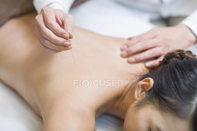 Young woman receiving acupuncture treatment, close-up — Stock Photo