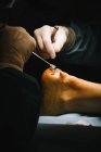 Le mani dei chirurghi fanno un'operazione al tendine d'Achille — Foto stock