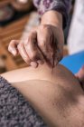 Nahaufnahme des Therapeuten, der Akupunktur am Patienten durchführt — Stockfoto