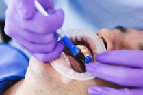 Крупним планом безликого жіночого лікаря в рукавичках нанесення фторидного гелю на зуб людини з рефрактором під час стоматологічного лікування в клініці — стокове фото