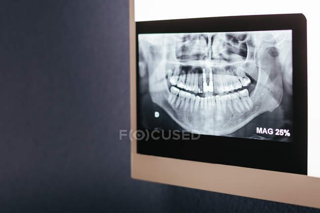 Стоматологічний рентгенівський знімок на лайтбоксі на стіні — стокове фото