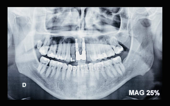Prise de vue complète de l'étude de radiographie dentaire — Photo de stock