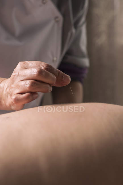 Therapist performing acupuncture treatment. — Stock Photo