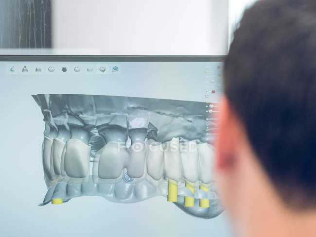 Homme modélisation prothèse dentaire sur ordinateur — Photo de stock