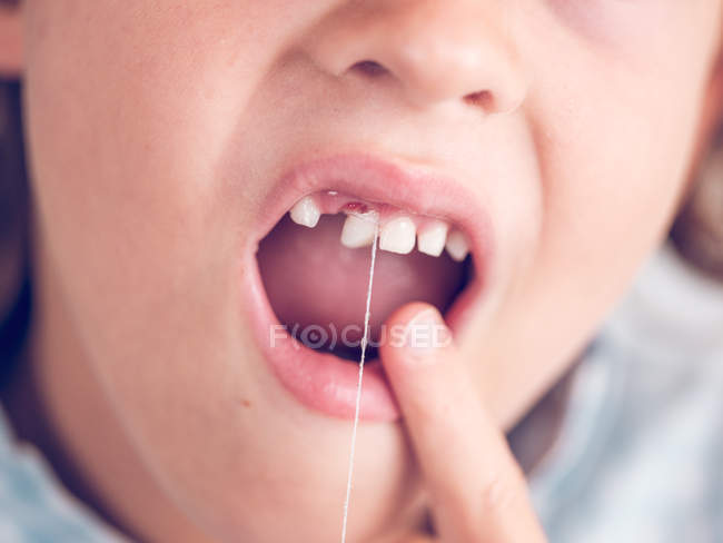 Primer plano del niño pequeño extrayendo diente lechoso delantero con hilo dental - foto de stock
