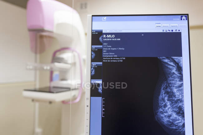 Unidad moderna de mamografía digital en clínica y pantalla - foto de stock