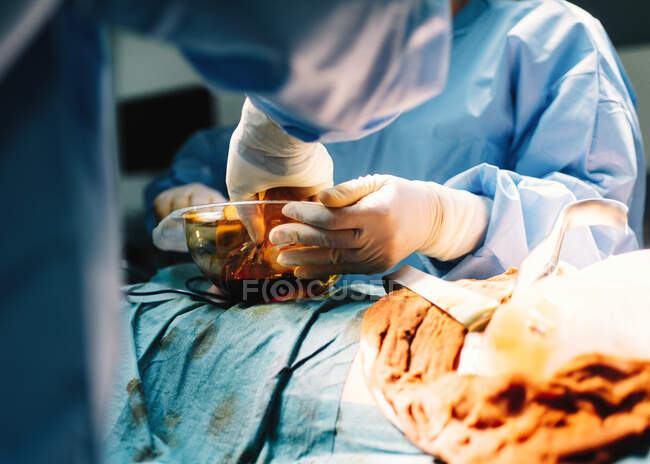 Руки лікаря, що тримають силіконовий імплантат грудей, і гола жінка-пацієнтка, яка лежала з ланцетом під час операції. — Stock Photo