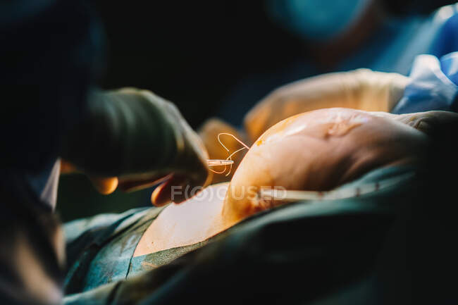 Plastic surgeon sewing up breast of female patient after inserting implants in operating room — Stock Photo