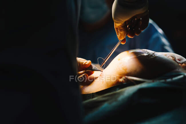 Chirurgien plastique coudre le sein d'une patiente après avoir inséré des implants dans la salle d'opération — Photo de stock