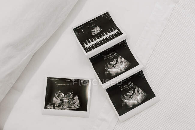 Top view of ultrasound scans of unborn baby placed bed in ward of fertility clinic — Stock Photo
