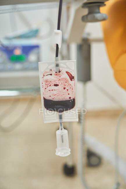Пластиковый пакет с донорской кровью во время процедуры переливания в современной медицинской лаборатории — стоковое фото