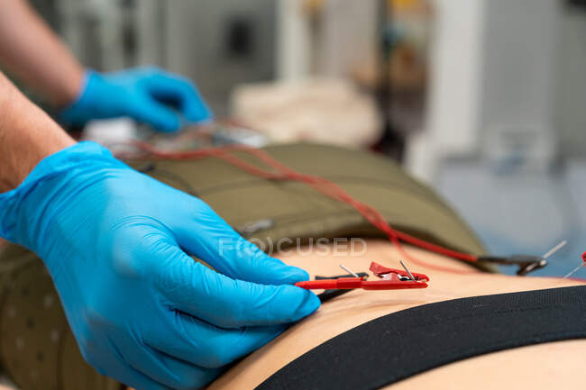 Crop unrecognizable physical therapist in sterile gloves inserting needle electrode into back skin of woman in hospital — Stock Photo