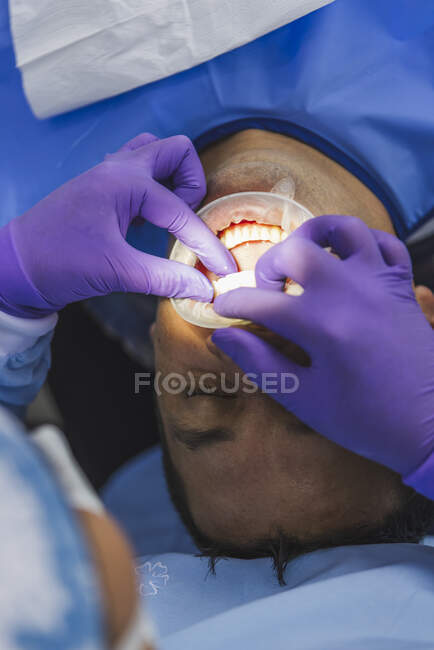High angle of crop orthodontist in gloves installing dental veneers on teeth for protection during appointment in clinic — Stock Photo