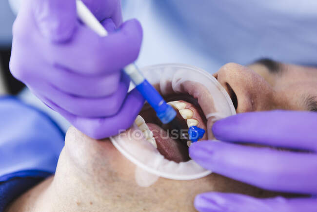 Nahaufnahme einer gesichtslosen Ärztin in Handschuhen, die während einer Zahnbehandlung in der Klinik Fluorid-Gel auf den Zahn eines Mannes mit Retraktor aufträgt — Stockfoto