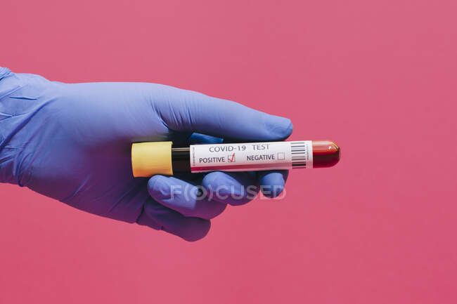 Mano de médico irreconocible recortada que muestra un análisis de sangre positivo de Coronavirus sobre un fondo rosado - foto de stock