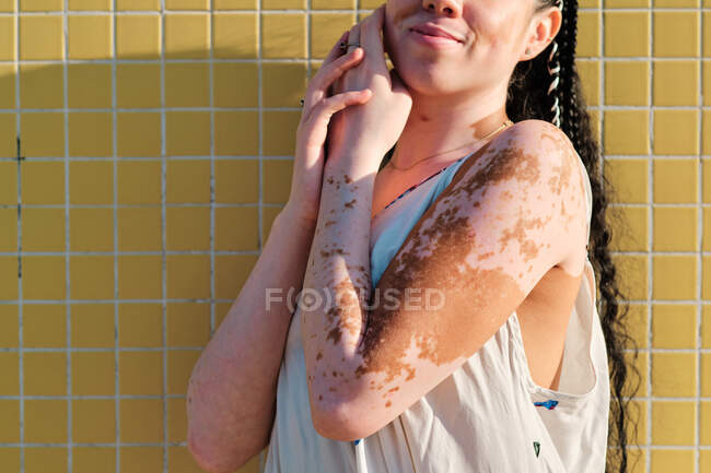 Урожай очаровательной женщины с кожей витилиго стоя против желтой плитки стены на улице в солнечный день — стоковое фото