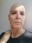 Portrait of a bald woman with cancer her hand on her neck — Stock Photo