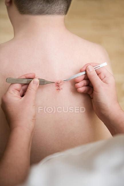 Close-up back view of Man having stitches removed — Stock Photo